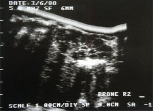 Neonatal kidney (1980, courtesy Roger Gent)