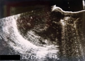 Neuroblastoma (1979, courtesy Roger Gent)