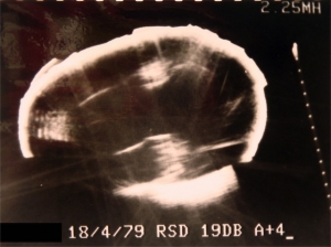 Compound paediatric head scan (1979, courtesy Roger Gent)