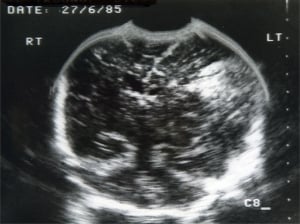 Paediatric head showing haemorrhage (1985, courtesy Roger Gent)