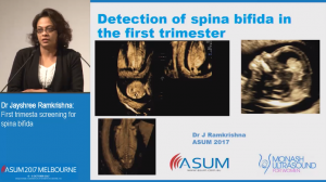 First trimester screening for spina bifida - Dr Jayshree Ramkrishna