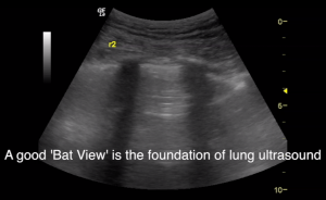 A good 'Bat View' is the foundation of lung ultrasound - Kylie Baker