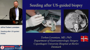 Seeding after US-guided biopsy - A/Prof Torben Lorentzen