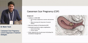 Diagnosis and management of Caesarean section scar pregnancy - Dr Mark Teoh