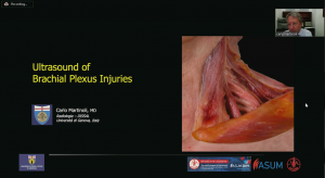 Ultrasound of brachial plexus injuries - Prof Carlo Martinoli