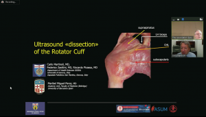 Ultrasound dissection of the rotator cuff - Prof Carlo Martinoli