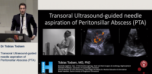 A novel technique for transoral ultrasound-guided aspiration of peritonsillar abscess – a single-arm feasibility study - Tobias Todsen